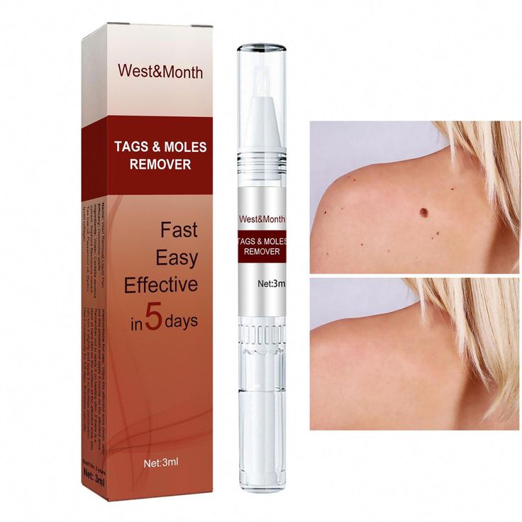 West&Month™ — Moles & Skin Tags Remover